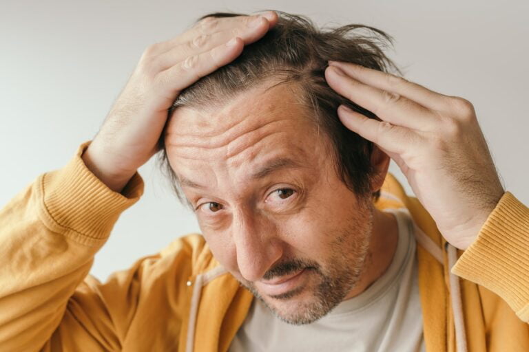 Hair loss, man looking at the mirror concerned about losing his hair at forehead